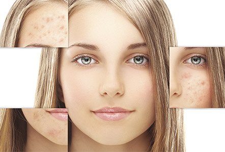 Mistakes to Avoid With Acne Laser Treatment post thumbnail image