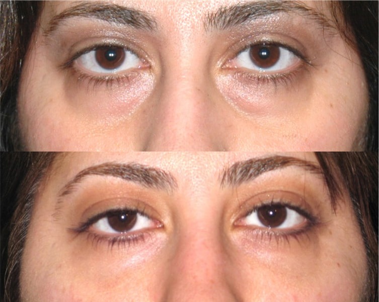 The blepharoplasty Santa Barbara warranties unparalleled effects post thumbnail image